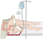 Enema Kit – Home & Ayurvedic Use - Image 4
